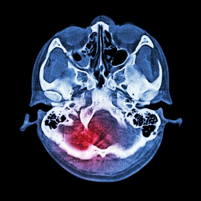 concussions and serious head injury lawyer